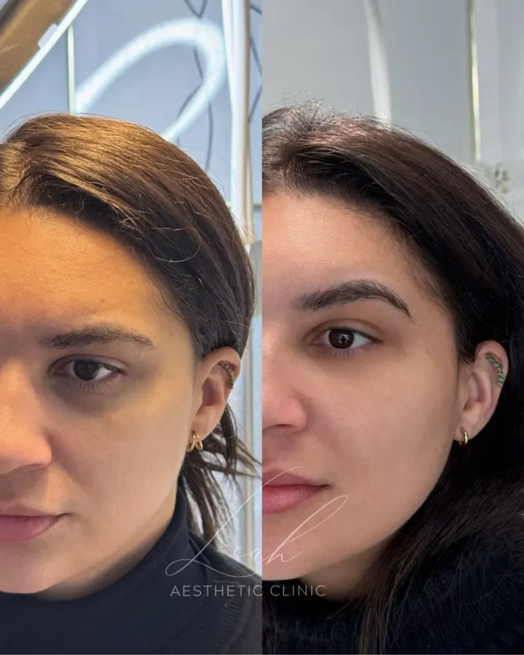 Under-eye area before and after treatment.