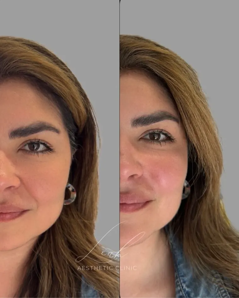 Full face before and after facial sculpting treatment.