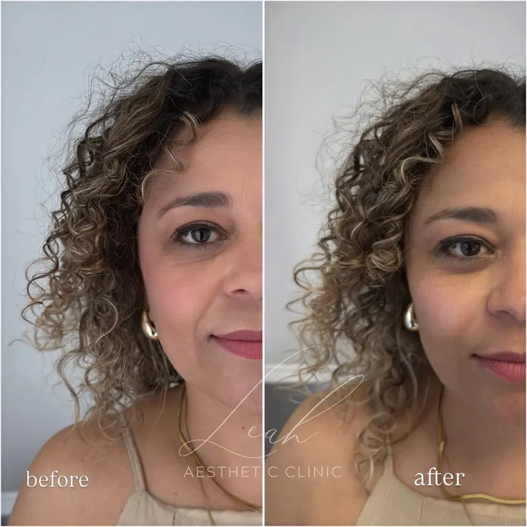 A client before and after facial treatment, labelled before and after.