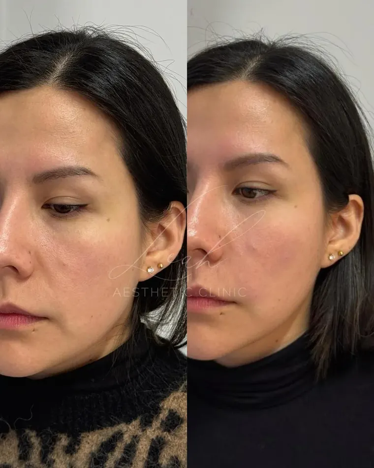 A client's face before and after treatment, with treated areas labelled.