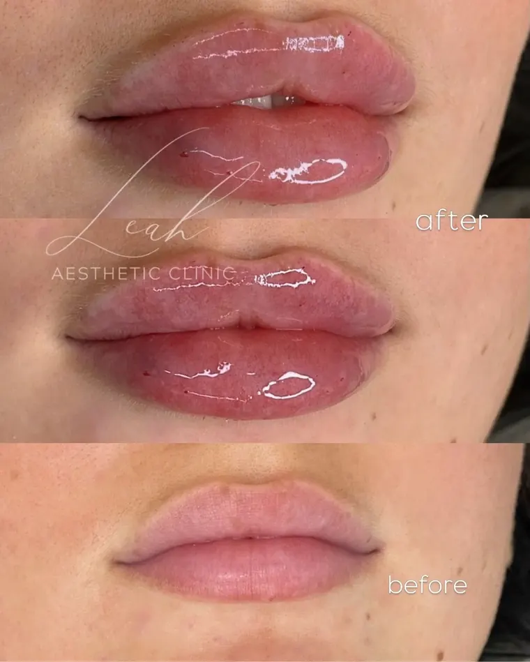 Lips before and after filler, shown one above the other.