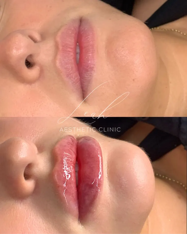 A second client's lips before and after filler.