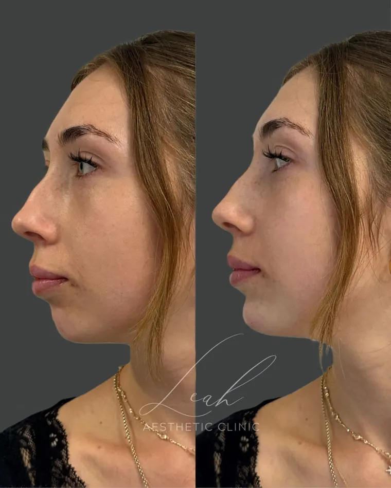 Chin and jawline profile before and after treatment.